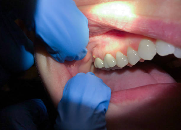 Best Emergency Dental Care for Sports Injuries in Bevil Oaks, TX